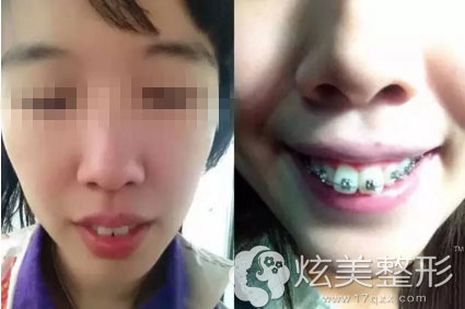 术前兔牙照和带上牙套照合肥佳德口腔 术前兔牙照和带上牙套照合肥佳德口腔