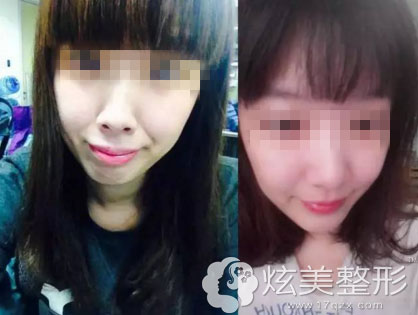 矫正牙齿前后闭嘴照合肥佳德口腔真人案例 矫正牙齿前后闭嘴照合肥佳德口腔真人案例