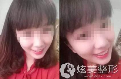 术后效果图真人案例合肥佳德口腔 术后效果图真人案例合肥佳德口腔