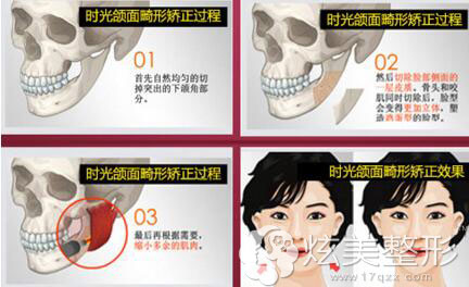 杭州时光下颌角矫正过程 杭州时光下颌角矫正过程
