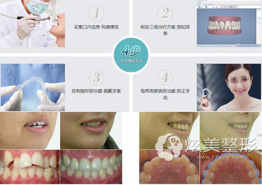 上海华美牙齿矫正过程及案例 上海华美牙齿矫正过程及案例