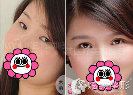双眼皮真人案例效果图深圳美莱 双眼皮真人案例效果图深圳美莱