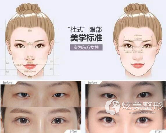 健康美眼真实案例上海美莱杜园园教授 健康美眼真实案例上海美莱杜园园教授