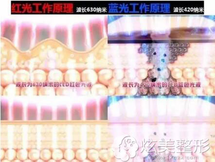 红蓝光祛痘示意图 红蓝光祛痘示意图