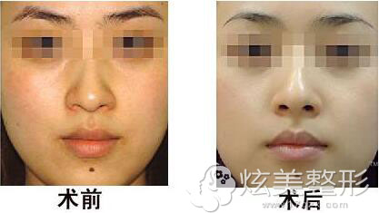 彩光嫩肤真人案例武汉美基元 彩光嫩肤真人案例武汉美基元