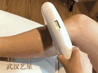 冰点脱毛过程动图 冰点脱毛过程动图