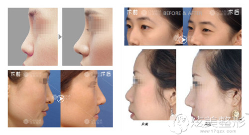 南昌佳美4D鼻综合整形真人案例 南昌佳美4D鼻综合整形真人案例