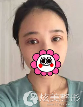 南京康美双眼皮失败修复术前睁眼也很明显痕迹 南京康美双眼皮失败修复术前睁眼也很明显痕迹
