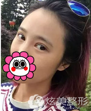 双眼皮失败修复南京康美真实经历 双眼皮失败修复南京康美真实经历