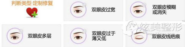双眼皮失败类型选择 双眼皮失败类型选择