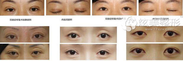 南京康美双眼皮失败修复经典案例分享 南京康美双眼皮失败修复经典案例分享