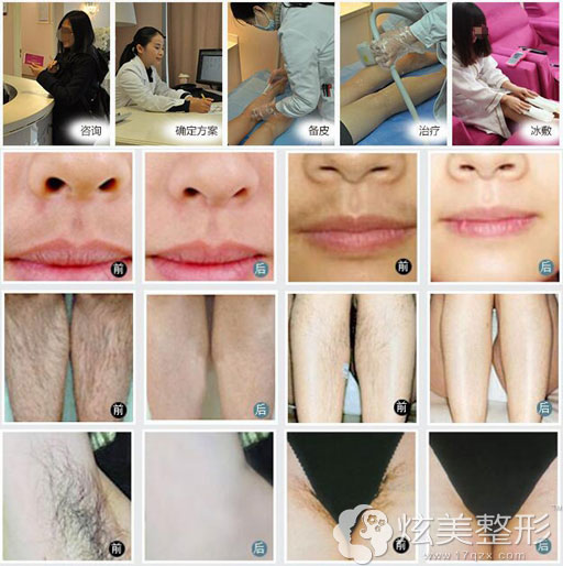 在深圳美莱脱毛流程以及更多案例图 在深圳美莱脱毛流程以及更多案例图