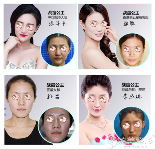 沈阳百嘉丽精准特效祛痘真人案例 沈阳百嘉丽精准特效祛痘真人案例