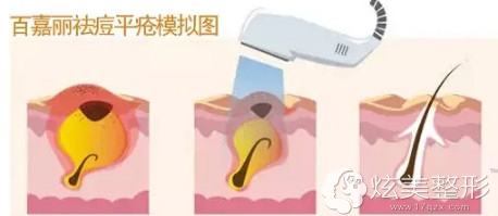 沈阳百嘉丽祛痘的原理 沈阳百嘉丽祛痘的原理