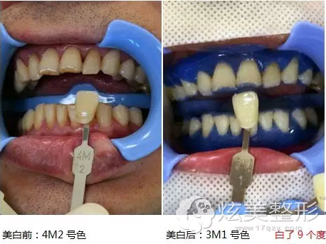 牙齿前后对比颜色广州和睦家真实案例 牙齿前后对比颜色广州和睦家真实案例