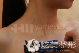 按照乳房黄金五维、胸线、胸围、胸廊、乳房半径、两乳距离的美学标准量身定制 按照乳房黄金五维、胸线、胸围、胸廊、乳房半径、两乳距离的美学标准量身定制