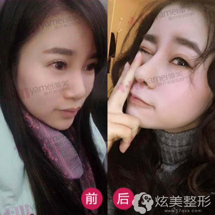 肖征刚医生假体隆鼻前后对比 肖征刚医生假体隆鼻前后对比
