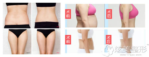 青岛壹美整形吸脂+射频真人案例 青岛壹美整形吸脂+射频真人案例