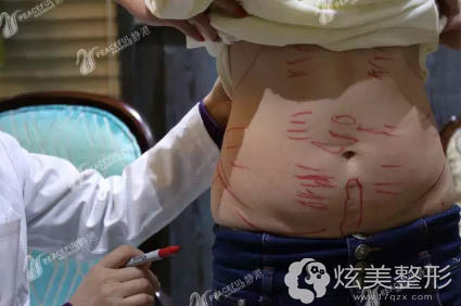 怀孕后脂肪堆积的肥胖腰腹 怀孕后脂肪堆积的肥胖腰腹