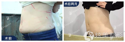 在杭州静港整形做完腰腹吸脂术前后对比 在杭州静港整形做完腰腹吸脂术前后对比