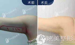 通过静港整形做完手臂吸脂术前后对比 通过静港整形做完手臂吸脂术前后对比