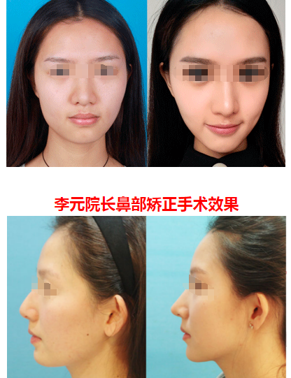 李元院长鼻部矫正手术效果 李元院长鼻部矫正手术效果