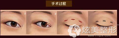 乌鲁木齐华美双眼皮手术过程 乌鲁木齐华美双眼皮手术过程