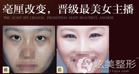 在乌鲁木齐华美找李艳霞医生做双眼皮案例 在乌鲁木齐华美找李艳霞医生做双眼皮案例