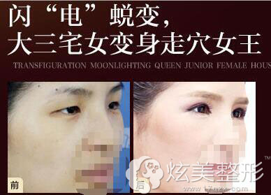 李艳霞医生双眼皮案例 李艳霞医生双眼皮案例