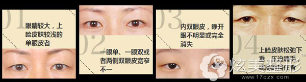 需要做双眼皮的多种眼部类型 需要做双眼皮的多种眼部类型