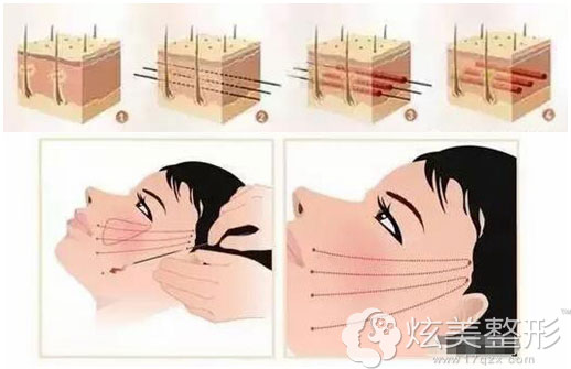 面部线雕提升原理 面部线雕提升原理