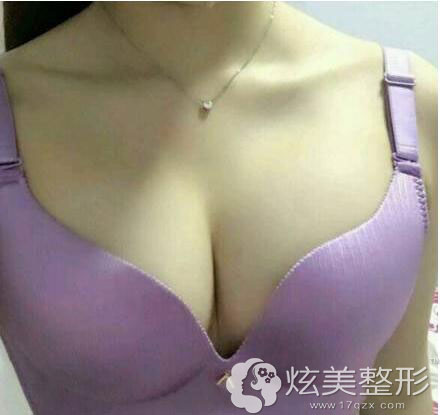 郑州集美整形隆胸术后第6天效果图 郑州集美整形隆胸术后第6天效果图