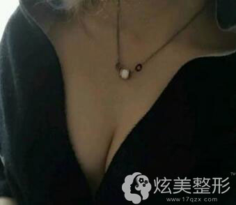 真人案例隆胸术后2个月效果图郑州集美整形 真人案例隆胸术后2个月效果图郑州集美整形