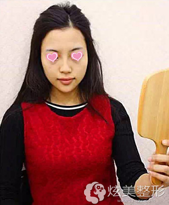 术后3周呈现完美脸型和五官 术后3周呈现完美脸型