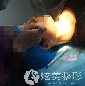 白院长先对我画线设计,精准测量 白院长先对我画线设计,精准测量