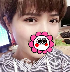 北京凯润婷双眼皮案例术后4天的样子 北京凯润婷双眼皮案例术后4天的样子