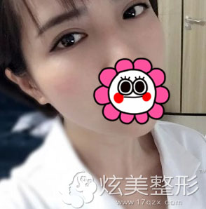 术后10天拆线北京凯润婷双眼皮案例 术后10天拆线北京凯润婷双眼皮案例