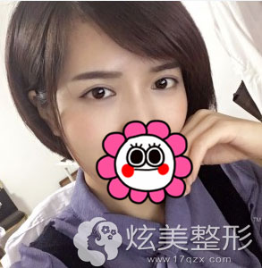 术后50天效果双眼皮案例凯润婷 术后50天效果双眼皮案例凯润婷
