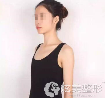 南宁华美假体隆胸术前图 南宁华美假体隆胸术前图