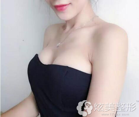 南宁华美隆胸术后20天效果图 南宁华美隆胸术后20天效果图