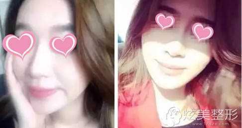 在太原华美注射玻尿酸第7天鼻子和下巴很自然 在太原华美注射玻尿酸第7天鼻子和下巴很自然