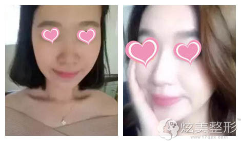 在太原华美整形注射玻尿酸隆鼻+下巴前后对比 在太原华美整形注射玻尿酸隆鼻+下巴前后对比