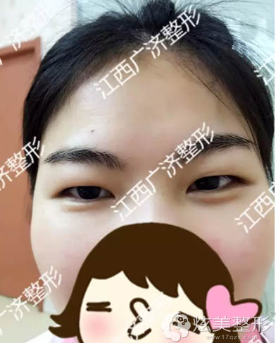��˫��Ƥ+���۽�ǰ��������