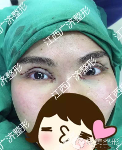 ���ϲ���ø�����˫��Ƥ+���۽�ʱ������