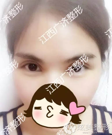 ˫��Ƥ+���۽�����1���º������