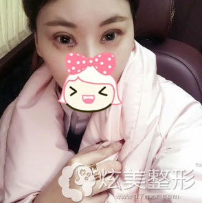 双眼皮术后6天效果图淮南华美整形 双眼皮术后6天效果图淮南华美整形