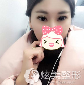 术后1个月效果图双眼皮淮南华美整形 术后1个月效果图双眼皮淮南华美整形