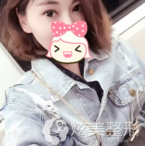 术后3个月效果图淮南华美整形双眼皮真人案例 术后3个月效果图淮南华美整形双眼皮真人案例