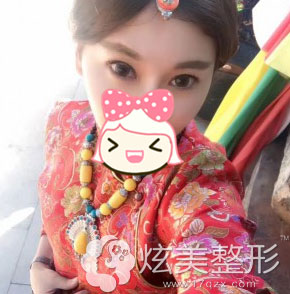 术后5个月效果图淮南华美整形双眼皮真人案例 术后5个月效果图淮南华美整形双眼皮真人案例