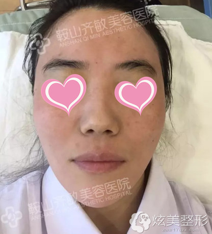 在鞍山齐敏整形准备做微针美肤 在鞍山齐敏整形准备做微针美肤